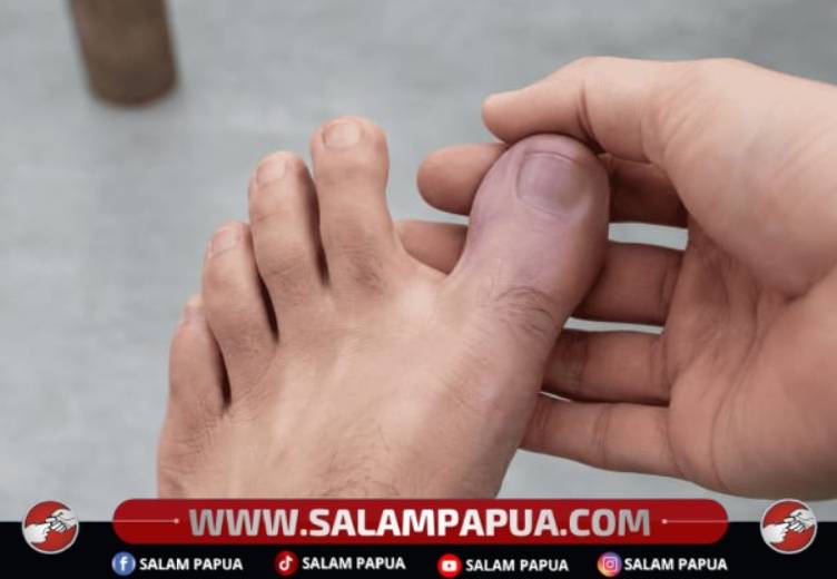 Jempol Kaki Kebas, Ini Penyebab Dan Cara Mengatasinya