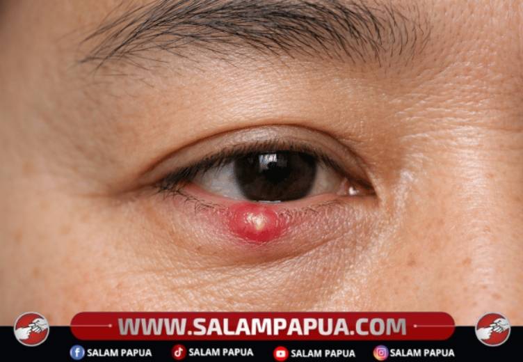 Mata Bisul, Ini Lho Penyebab Dan Cara Mengatasinya