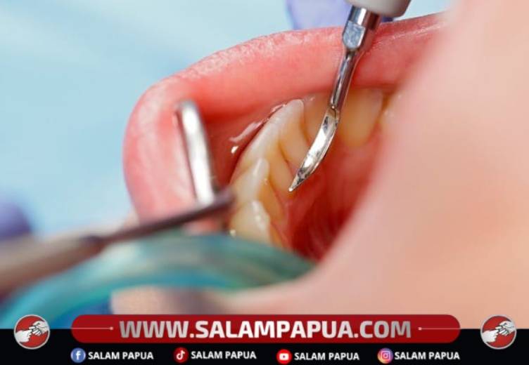 Apa Saja Efek Karang Gigi Dan Cara Mencegahnya?