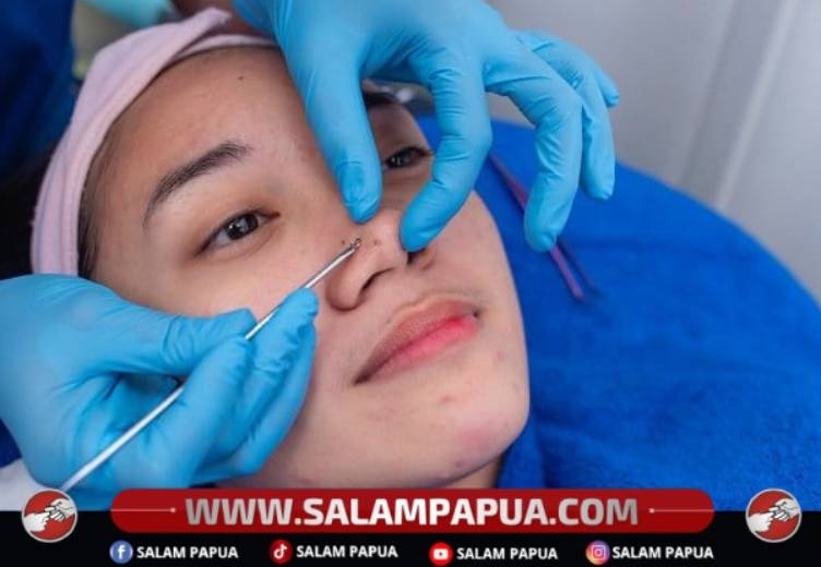 5 Cara Menghilangkan Komedo Paling Ampuh Dan Aman