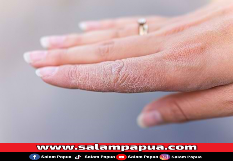 7 Cara Merawat Kulit Kering Agar Dapat Tampil Percaya Diri