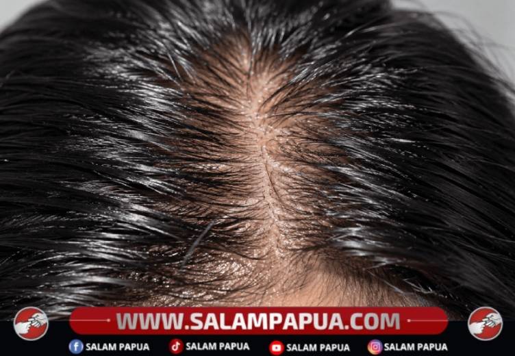 Kulit Kepala Berminyak, Ini Penyebab Dan Cara Mencegahnya